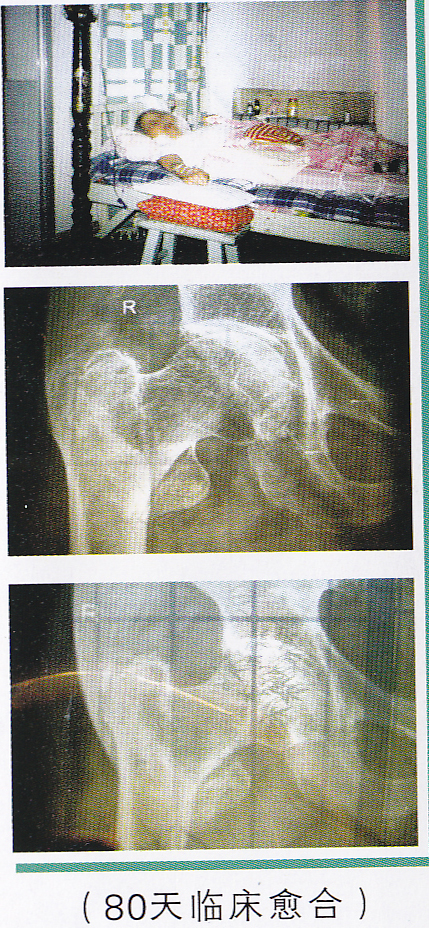 非手术治疗老年人股骨颈骨折的图
